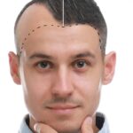 Before and after hair transplant photo illustrating the restoration of a receding hairline in a male patient.