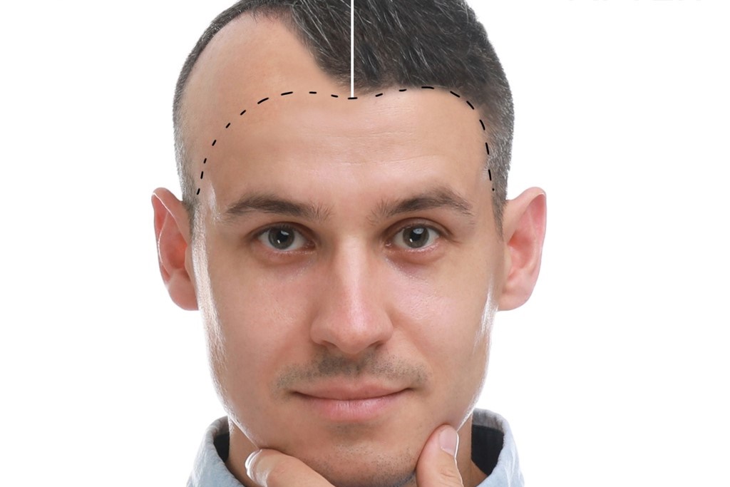 Istanbul Hair Transplant Top 5 Clinics-Reviews and Prices