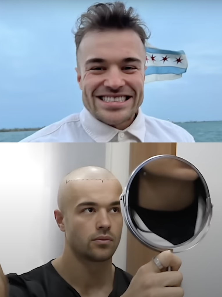 Side-by-side comparison of Mo’s hair before and after his hair transplant, showing significant improvement in hair density and hairline restoration.
