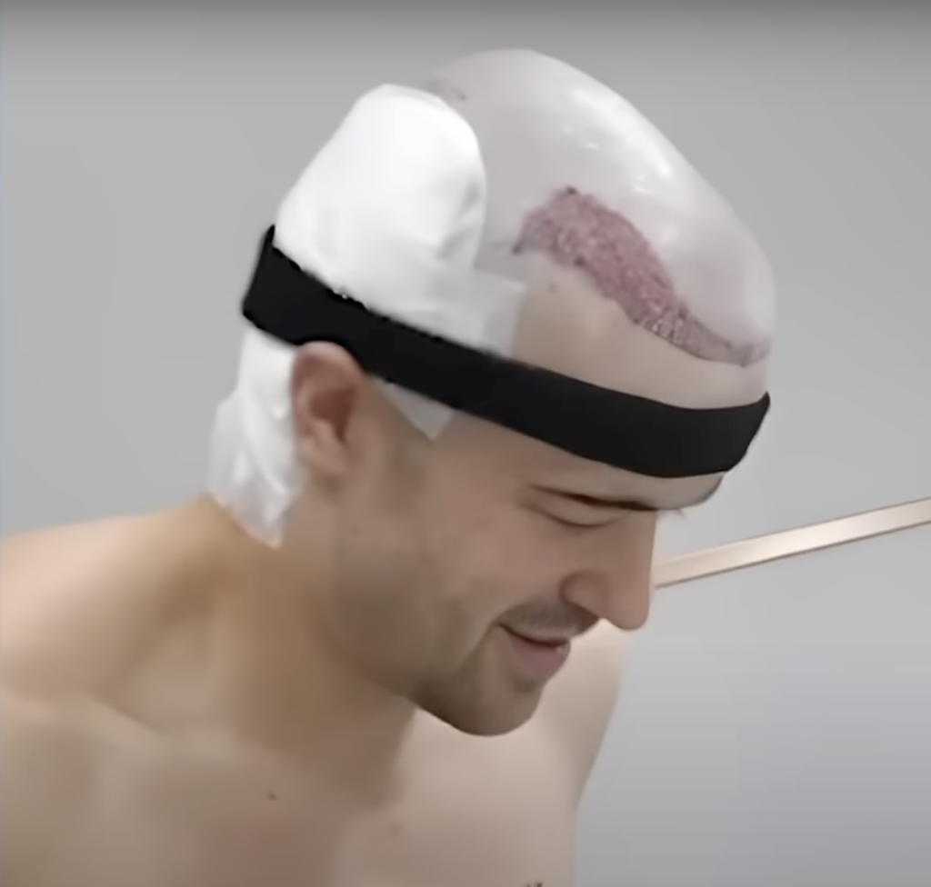 A close-up of Mo's hairline, showcasing hair density and hair growth pattern.