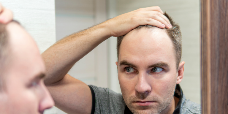 A man standing in front of a mirror, pulling back his hair with one hand to inspect a receding hairline.